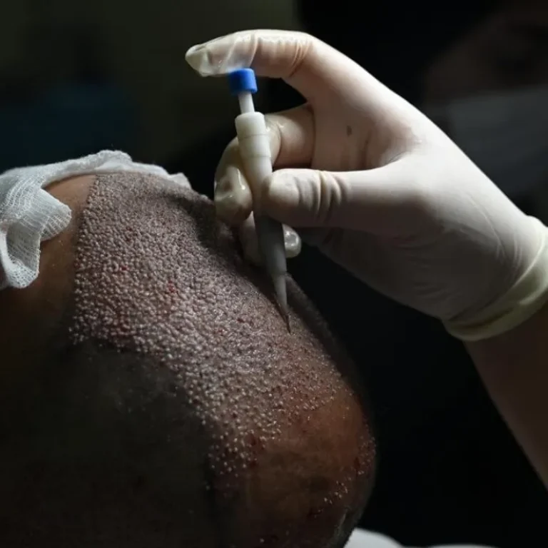 direct-hair-implantation